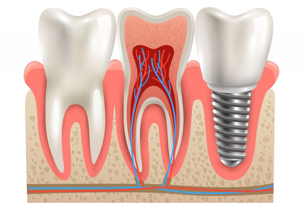 Dental-implant