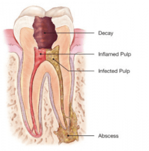 tooth Extraction