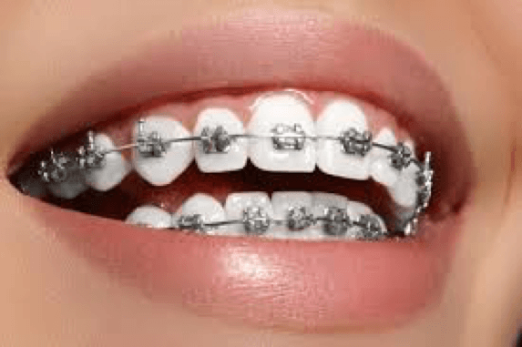 METAL BRACES