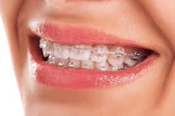 2. CERAMIC TRADITIONAL BRACES