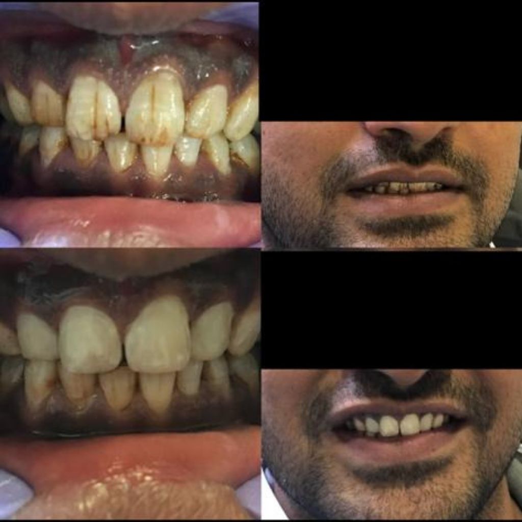 Dental Bleaching of Front upper 4 teeth.