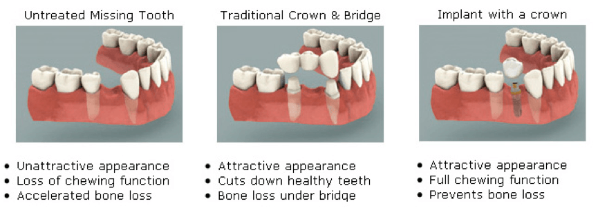 Dental Implant And Crown