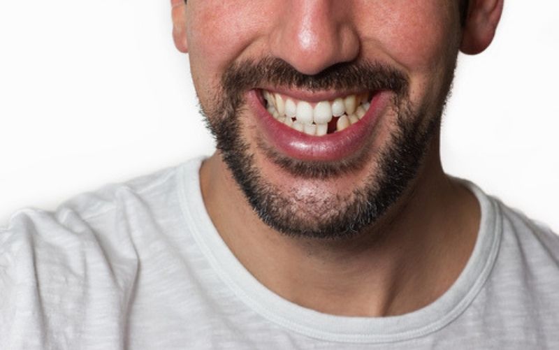 Replacing Missing teeth