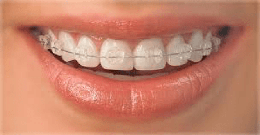 SELF LIGATING CERAMIC BRACES