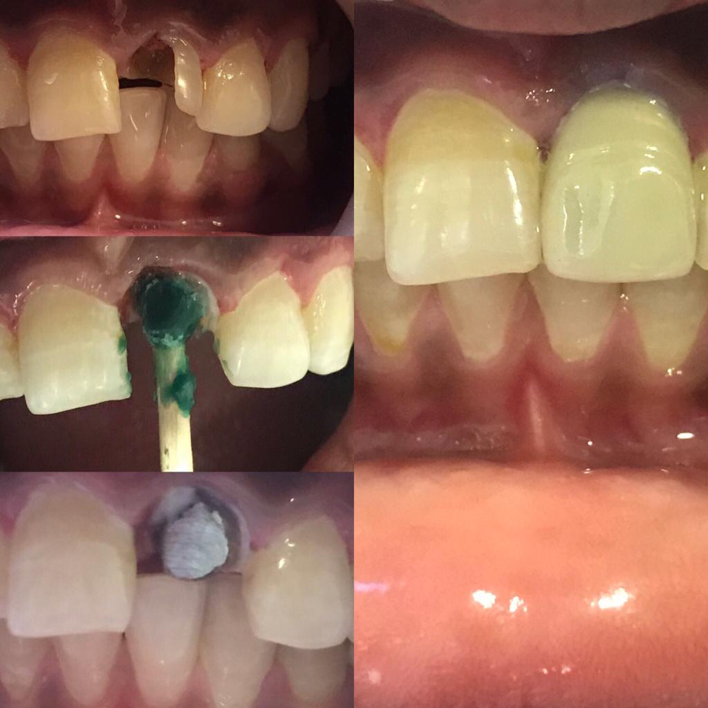 Post and Core build up of Front Upper Tooth