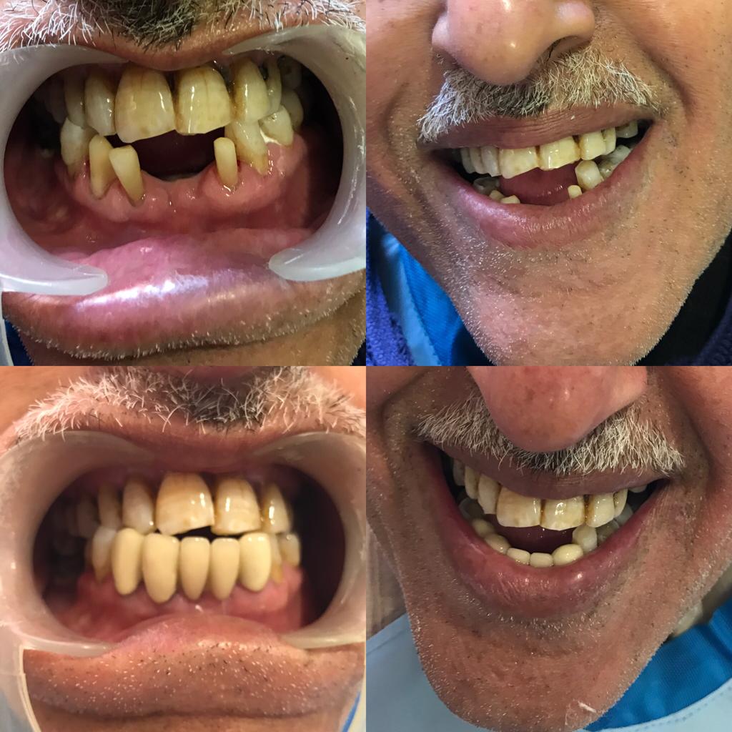 Replacing front lower teeth with fixed crowns and bridges