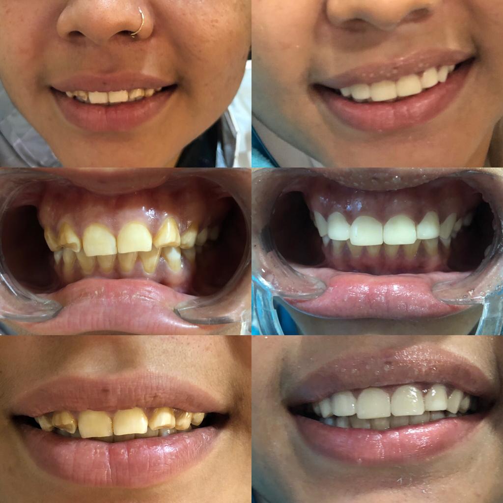 re designing a smile using composite veneers.