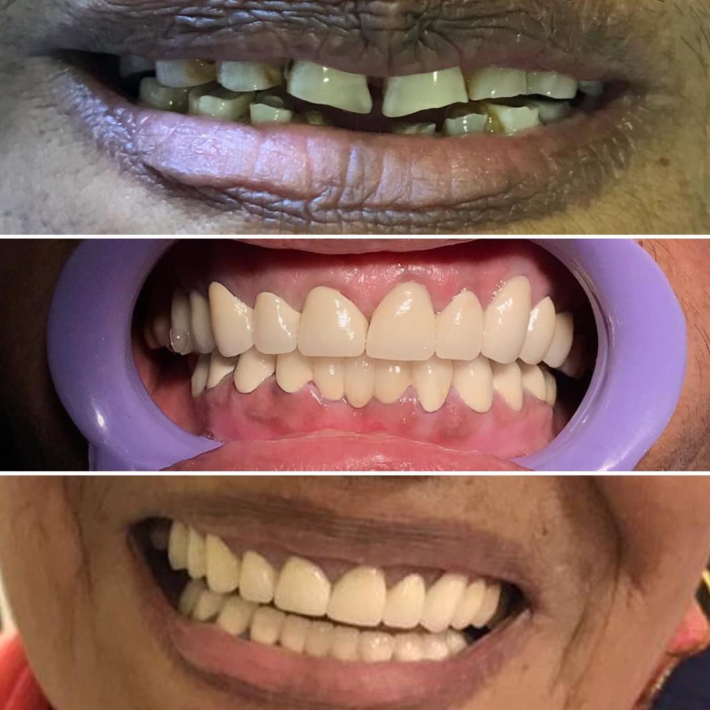 Redesigned smile using Fixed Crowns and Bridges.