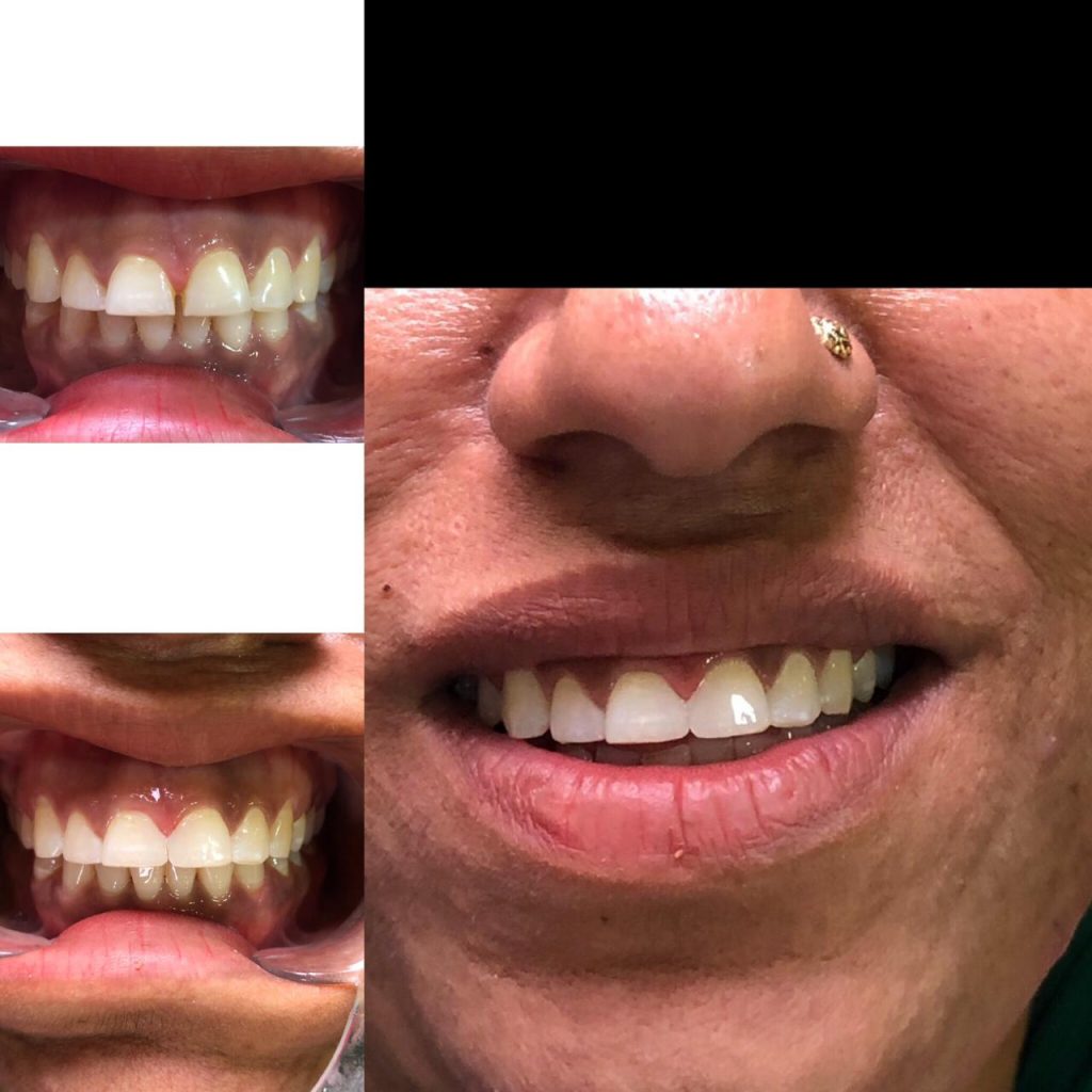 Closing the gap between 2 from teeth.