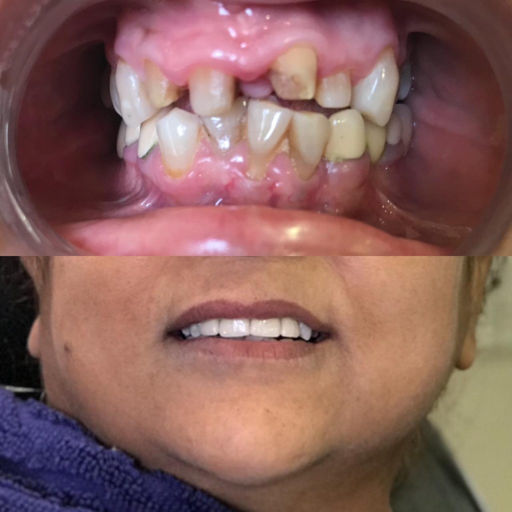 Smile Makeover using Dental Crowns