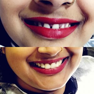 Quick Smile Makeovers using Filling materials.
