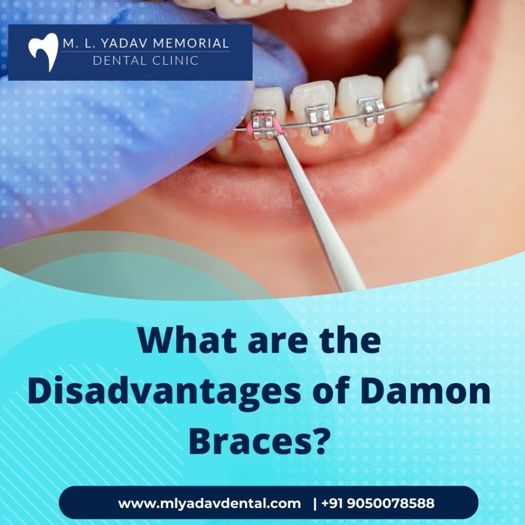 Disadvantages of Damon braces