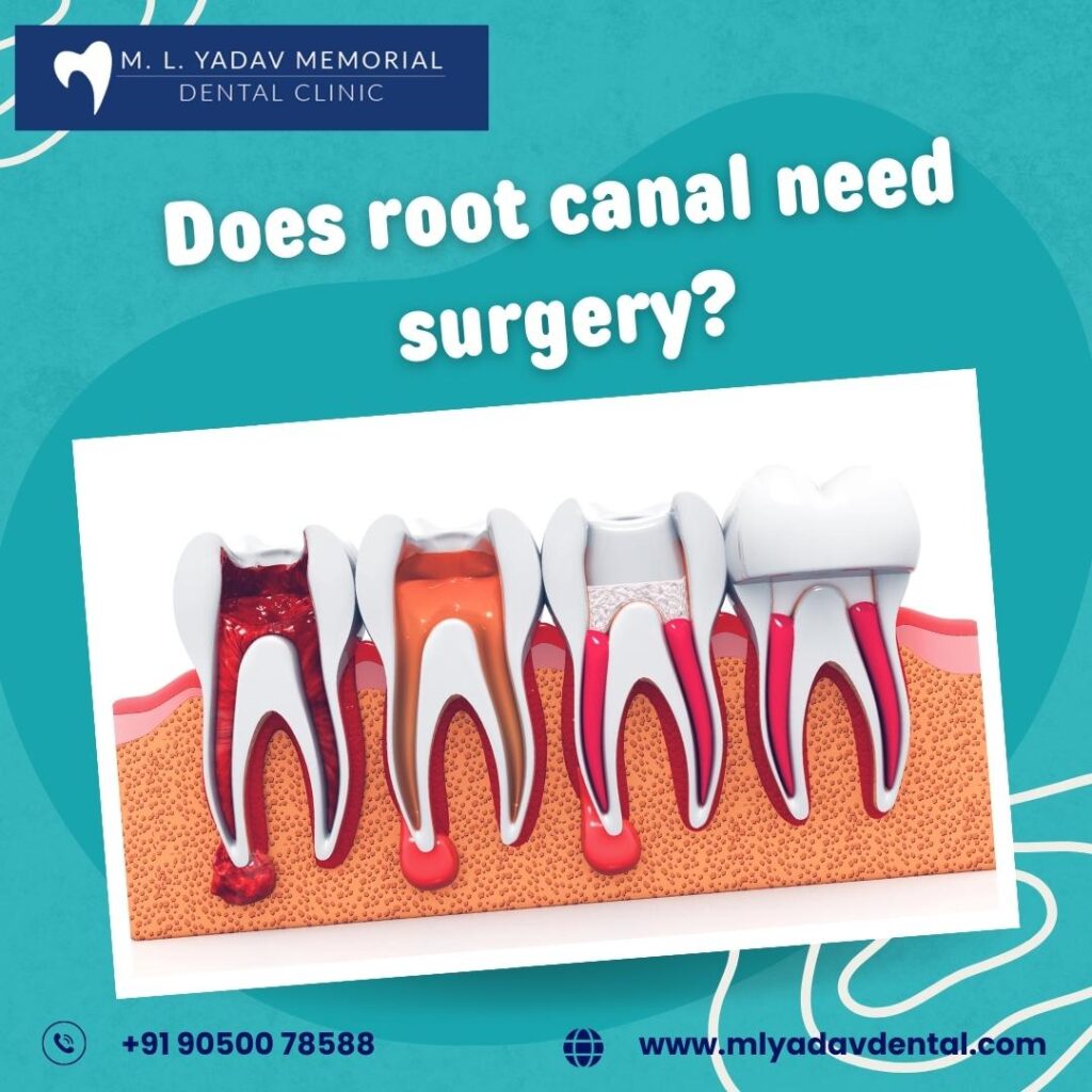 Does Root Canal Need Surgery?