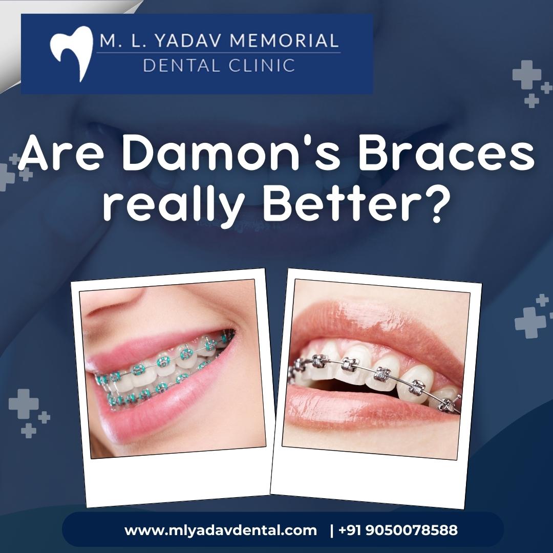 Are Damon's Braces Really Better?