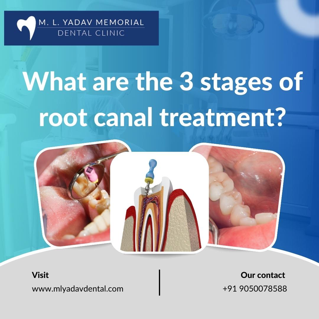 What are the 3 Stages of Root Canal Treatment?