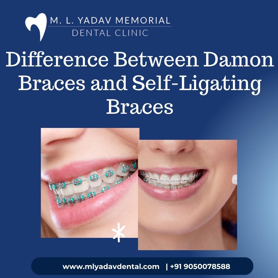 Difference Between Damon Braces and Self-Ligating Braces