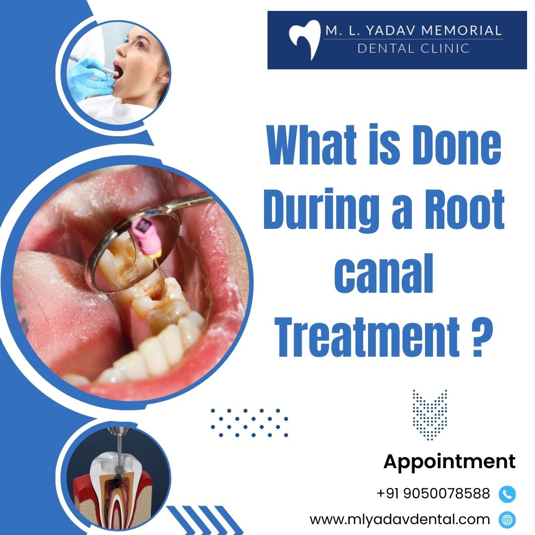 What is Done During a Root Canal Treatment?