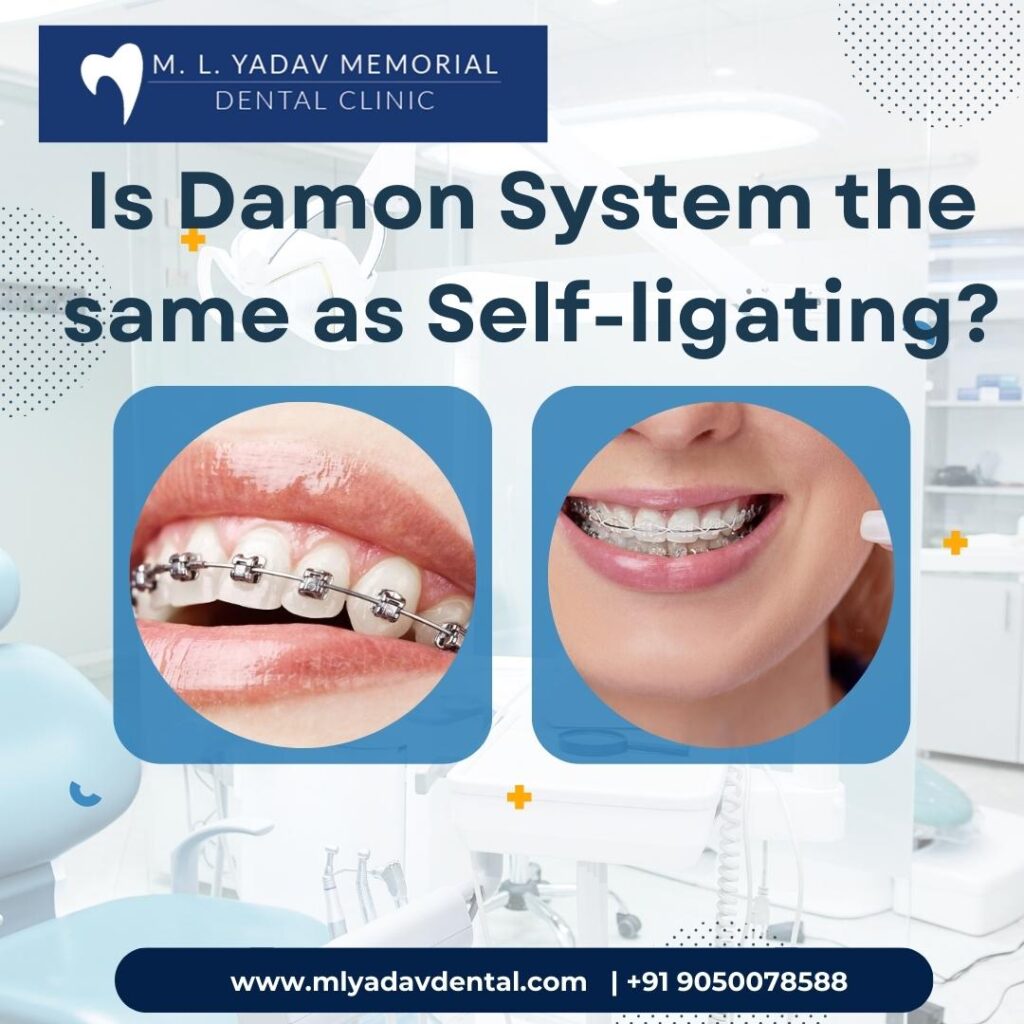 Is Damon System the same as Self-ligating?